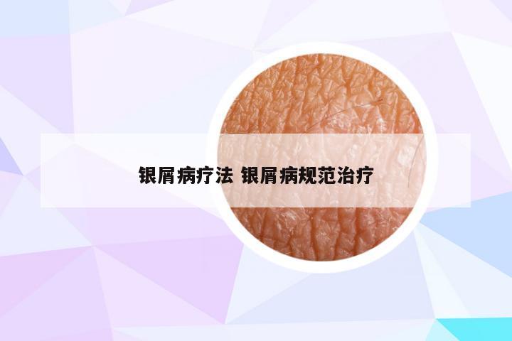 银屑病疗法 银屑病规范治疗