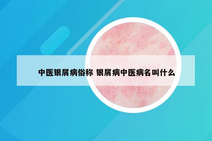 中医银屑病俗称 银屑病中医病名叫什么