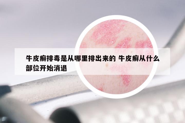 牛皮癣排毒是从哪里排出来的 牛皮癣从什么部位开始消退