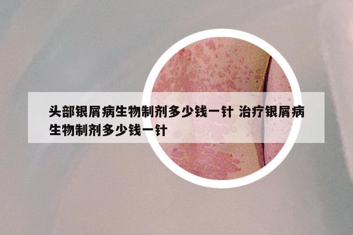 头部银屑病生物制剂多少钱一针 治疗银屑病生物制剂多少钱一针