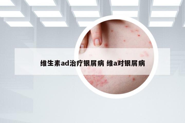 维生素ad治疗银屑病 维a对银屑病