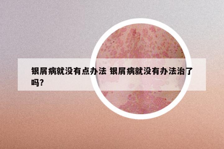 银屑病就没有点办法 银屑病就没有办法治了吗?