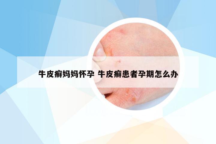 牛皮癣妈妈怀孕 牛皮癣患者孕期怎么办
