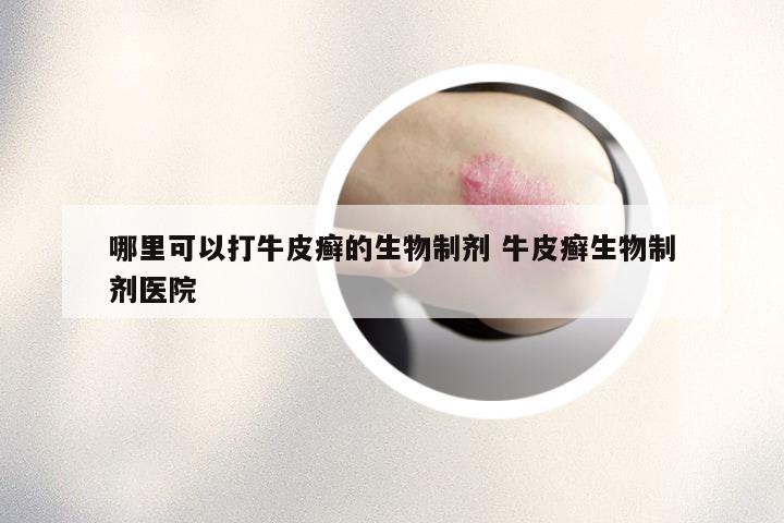 哪里可以打牛皮癣的生物制剂 牛皮癣生物制剂医院