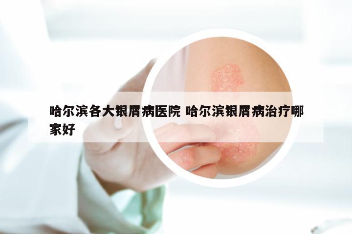 哈尔滨各大银屑病医院 哈尔滨银屑病治疗哪家好