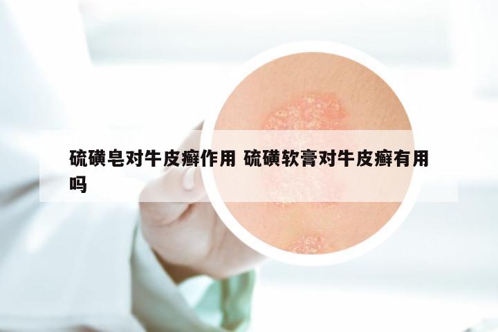 硫磺皂对牛皮癣作用 硫磺软膏对牛皮癣有用吗