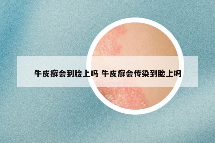 牛皮癣会到脸上吗 牛皮癣会传染到脸上吗