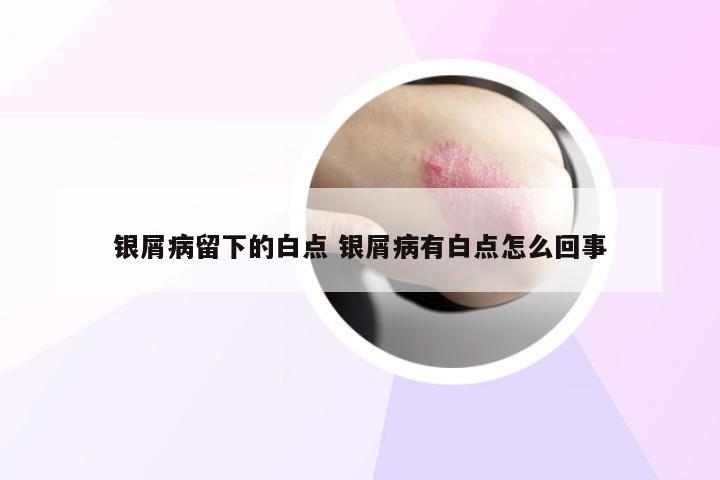 银屑病留下的白点 银屑病有白点怎么回事