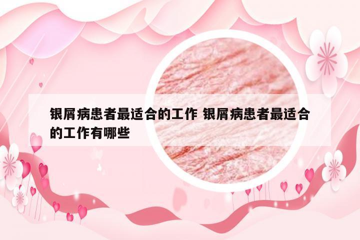 银屑病患者最适合的工作 银屑病患者最适合的工作有哪些