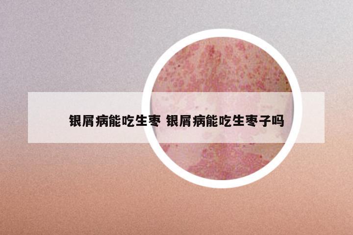 银屑病能吃生枣 银屑病能吃生枣子吗