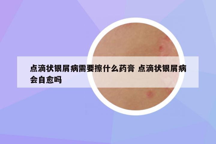 点滴状银屑病需要擦什么药膏 点滴状银屑病会自愈吗