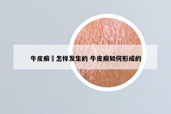 牛皮癣昰怎样发生的 牛皮癣如何形成的