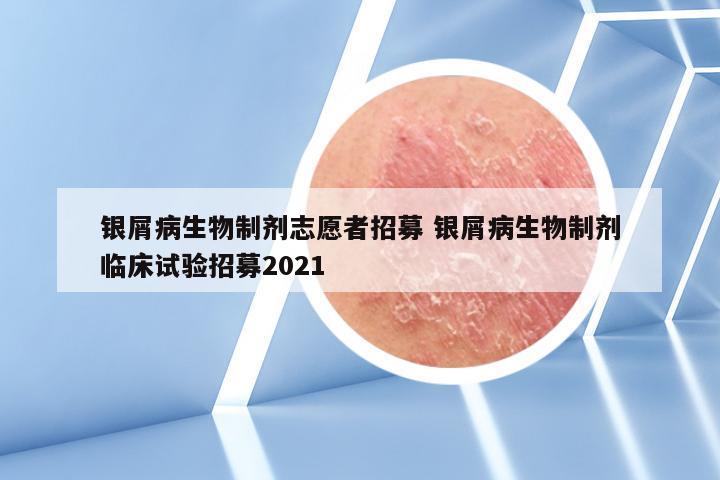 银屑病生物制剂志愿者招募 银屑病生物制剂临床试验招募2021