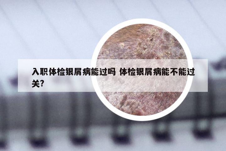 入职体检银屑病能过吗 体检银屑病能不能过关?