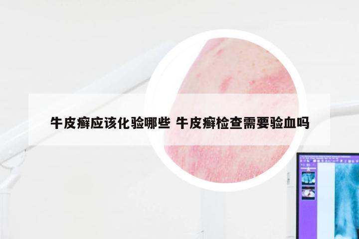 牛皮癣应该化验哪些 牛皮癣检查需要验血吗