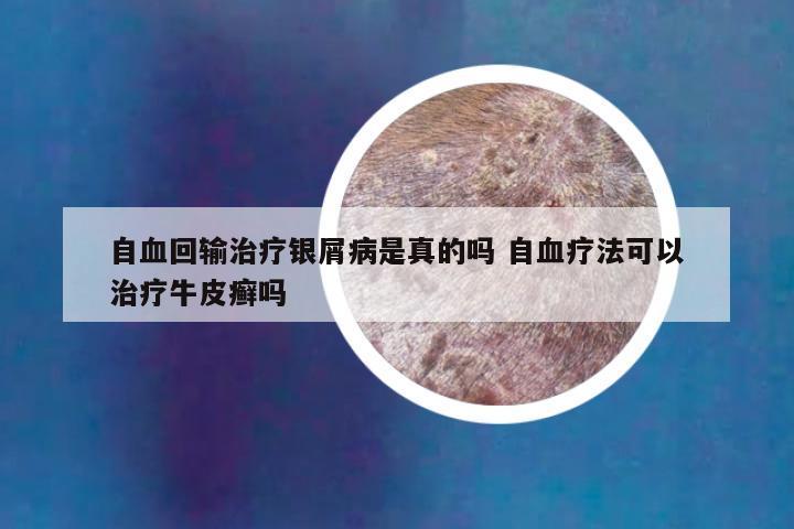 自血回输治疗银屑病是真的吗 自血疗法可以治疗牛皮癣吗