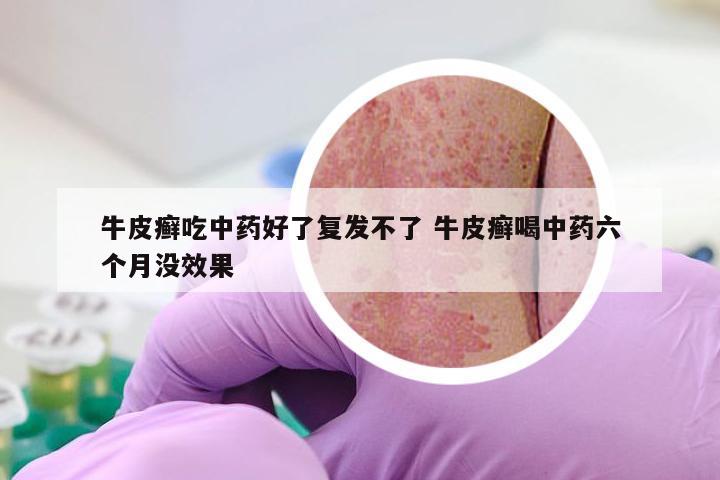 牛皮癣吃中药好了复发不了 牛皮癣喝中药六个月没效果