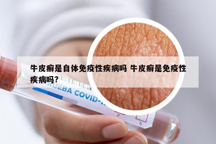 牛皮癣是自体免疫性疾病吗 牛皮癣是免疫性疾病吗?