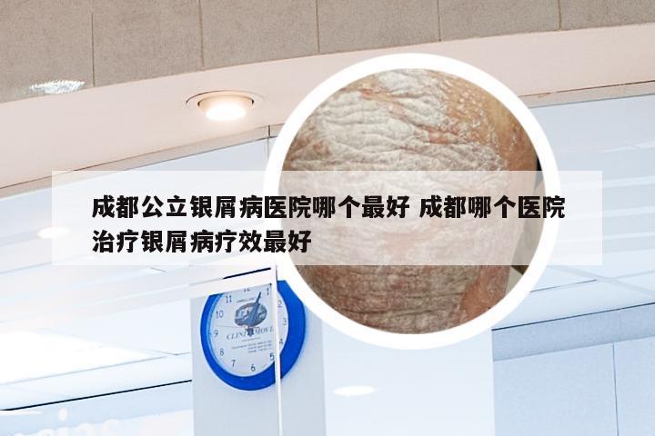 成都公立银屑病医院哪个最好 成都哪个医院治疗银屑病疗效最好