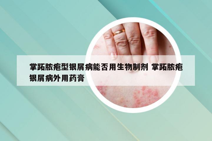 掌跖脓疱型银屑病能否用生物制剂 掌跖脓疱银屑病外用药膏