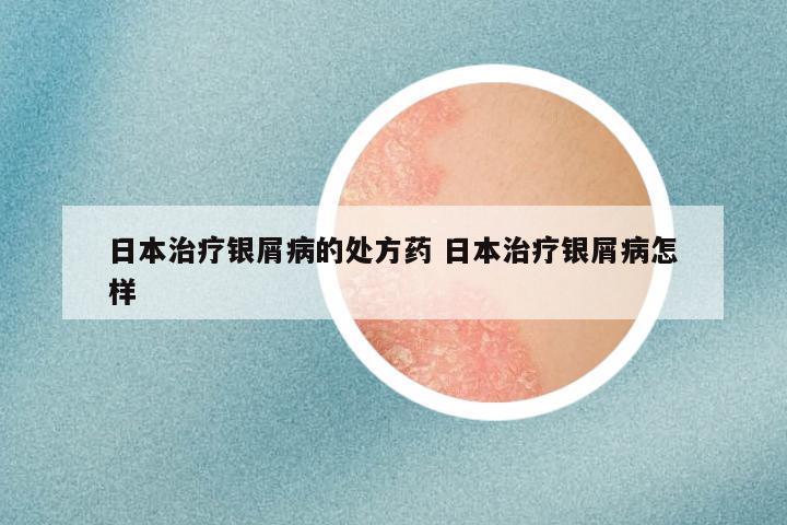 日本治疗银屑病的处方药 日本治疗银屑病怎样