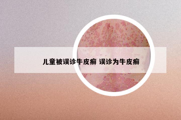儿童被误诊牛皮癣 误诊为牛皮癣