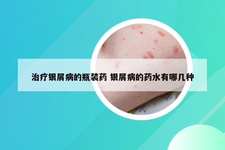 治疗银屑病的瓶装药 银屑病的药水有哪几种