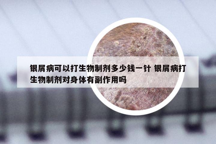 银屑病可以打生物制剂多少钱一针 银屑病打生物制剂对身体有副作用吗