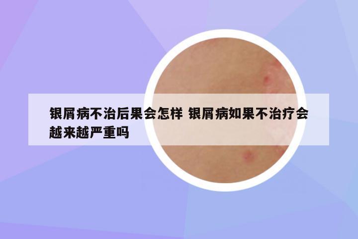 银屑病不治后果会怎样 银屑病如果不治疗会越来越严重吗