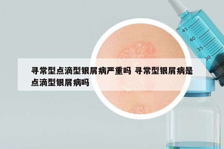 寻常型点滴型银屑病严重吗 寻常型银屑病是点滴型银屑病吗