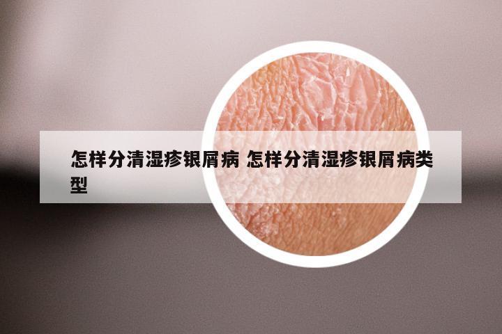 怎样分清湿疹银屑病 怎样分清湿疹银屑病类型