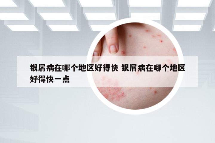 银屑病在哪个地区好得快 银屑病在哪个地区好得快一点