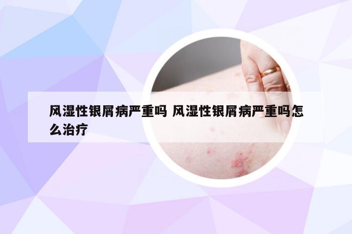 风湿性银屑病严重吗 风湿性银屑病严重吗怎么治疗