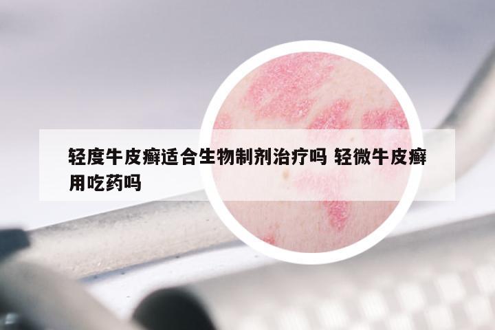 轻度牛皮癣适合生物制剂治疗吗 轻微牛皮癣用吃药吗