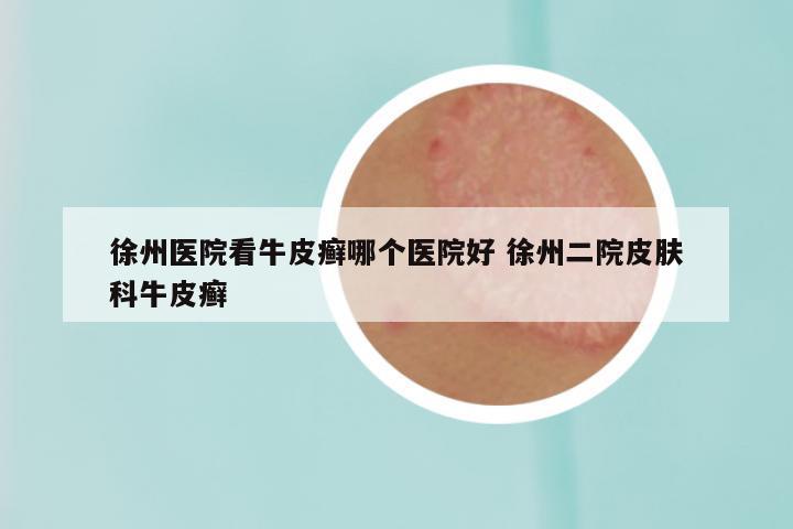 徐州医院看牛皮癣哪个医院好 徐州二院皮肤科牛皮癣