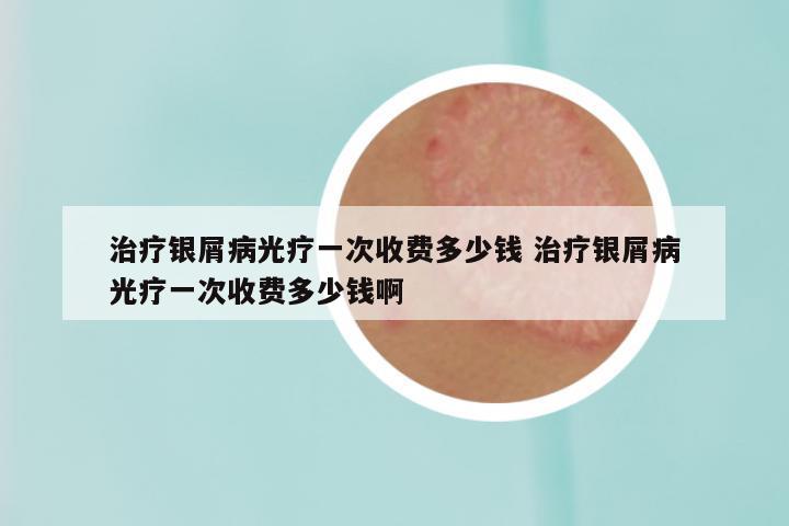 治疗银屑病光疗一次收费多少钱 治疗银屑病光疗一次收费多少钱啊