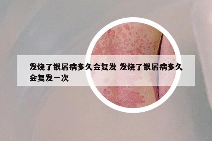 发烧了银屑病多久会复发 发烧了银屑病多久会复发一次