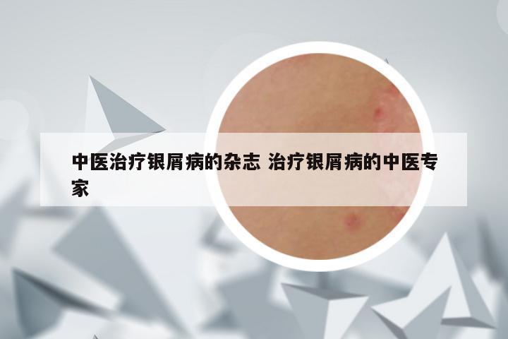 中医治疗银屑病的杂志 治疗银屑病的中医专家