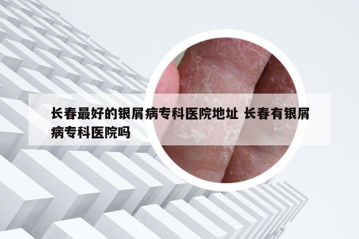 长春最好的银屑病专科医院地址 长春有银屑病专科医院吗