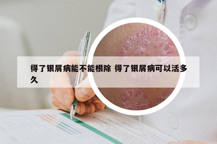 得了银屑病能不能根除 得了银屑病可以活多久