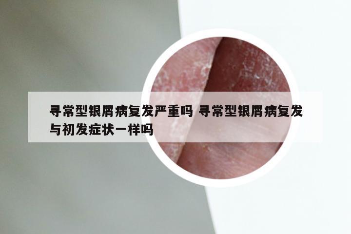 寻常型银屑病复发严重吗 寻常型银屑病复发与初发症状一样吗
