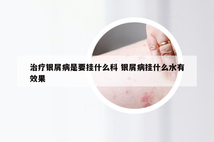 治疗银屑病是要挂什么科 银屑病挂什么水有效果