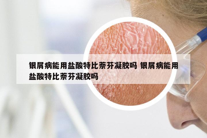 银屑病能用盐酸特比萘芬凝胶吗 银屑病能用盐酸特比萘芬凝胶吗