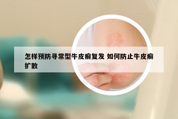 怎样预防寻常型牛皮癣复发 如何防止牛皮癣扩散