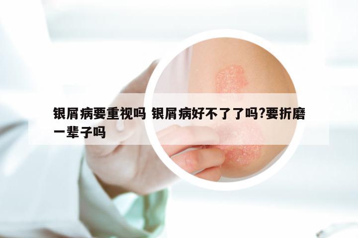 银屑病要重视吗 银屑病好不了了吗?要折磨一辈子吗
