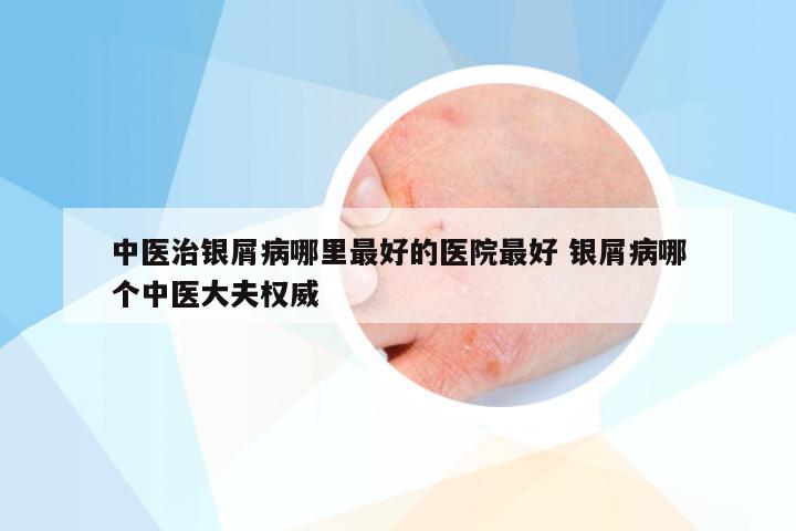中医治银屑病哪里最好的医院最好 银屑病哪个中医大夫权威