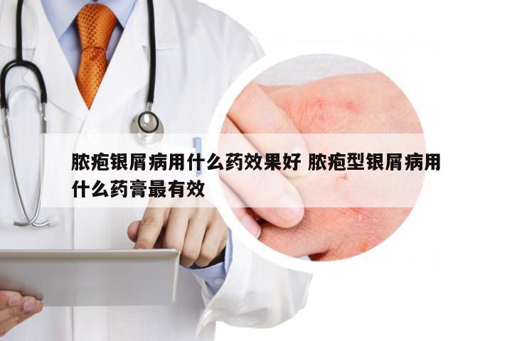 脓疱银屑病用什么药效果好 脓疱型银屑病用什么药膏最有效