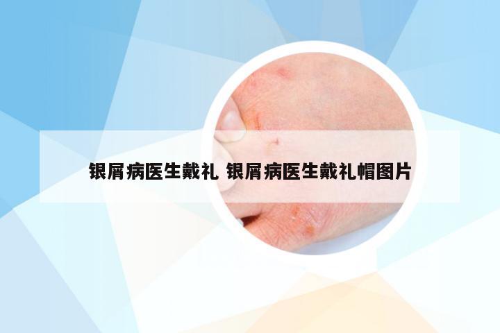 银屑病医生戴礼 银屑病医生戴礼帽图片