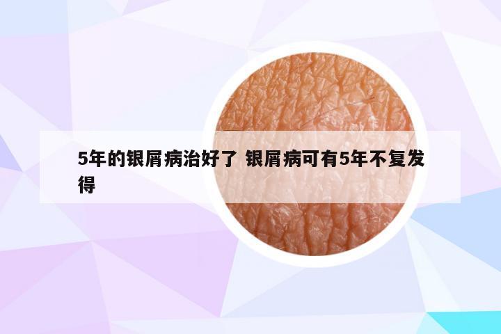 5年的银屑病治好了 银屑病可有5年不复发得