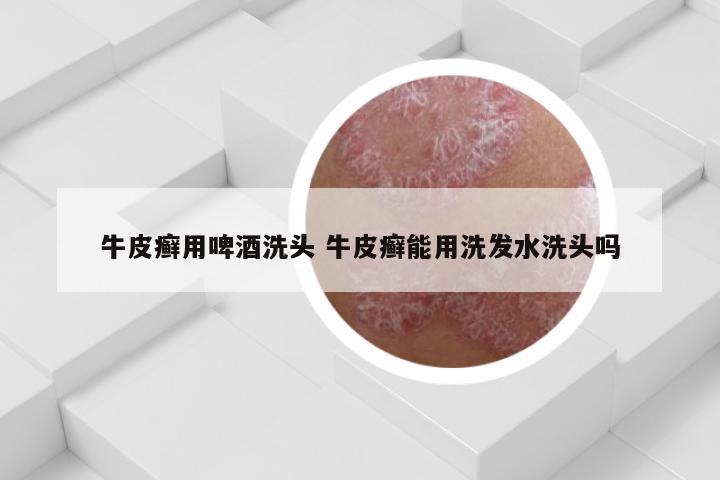 牛皮癣用啤酒洗头 牛皮癣能用洗发水洗头吗
